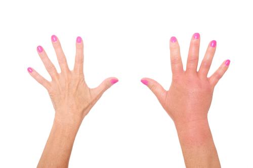 A woman's hands shown with edema 